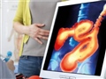Radio Federal - Actualidad - CONTINÚA LA CAMPAÑA DE PREVENCIÓN DEL CÁNCER COLORECTAL